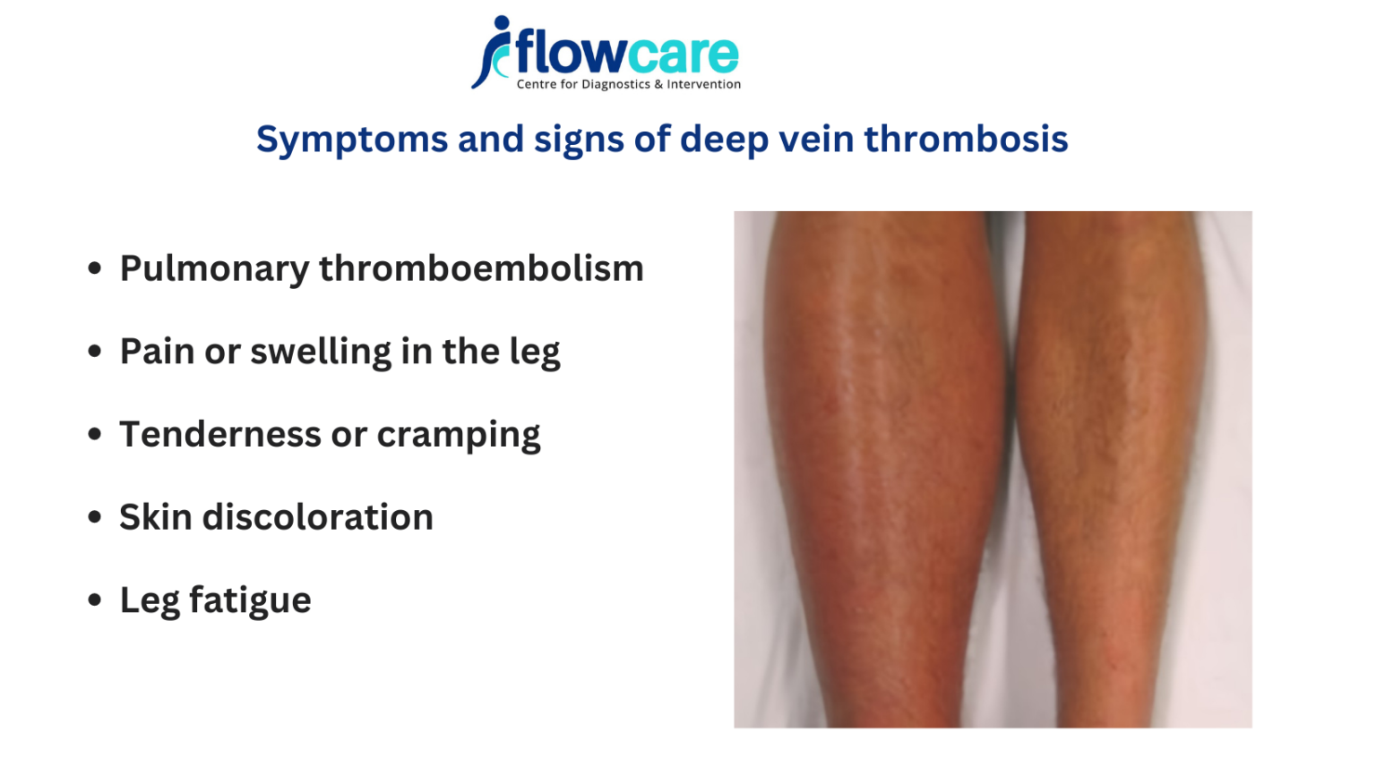 Managing Deep Vein Thrombosis Symptoms with FlowCare