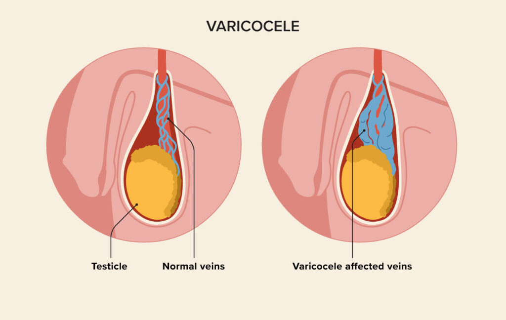 Guide to Managing Varicocele with Flowcare Varicocele Diet