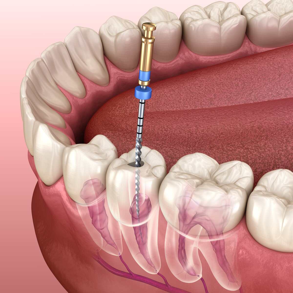 Why is Root Canal Therapy Necessary?