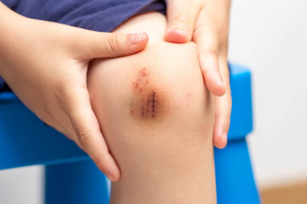 Treatment and Prevention of Scraped Knee