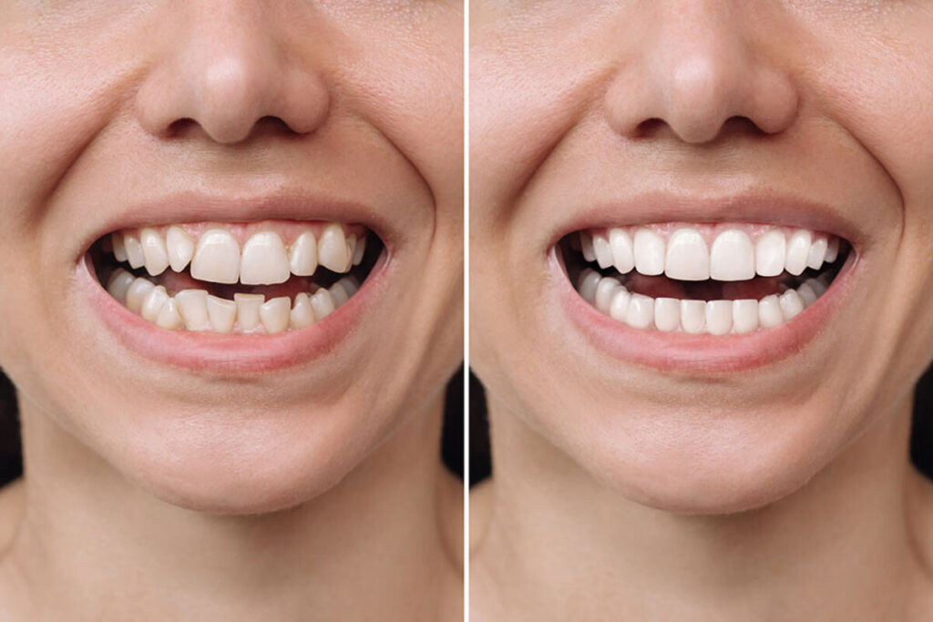 The Benefits of Porcelain Veneers: Achieve a Perfect Smile