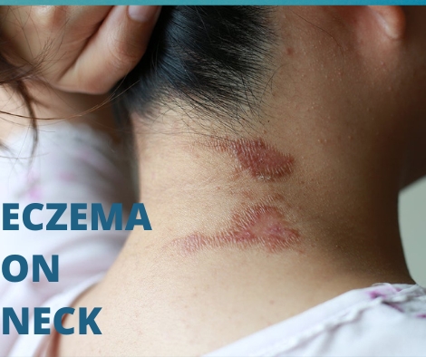 Eczema on the Neck in Children: What Parents Should Know