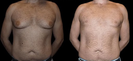 Importance of Follow-Up Care After Male Breast Reduction Sur