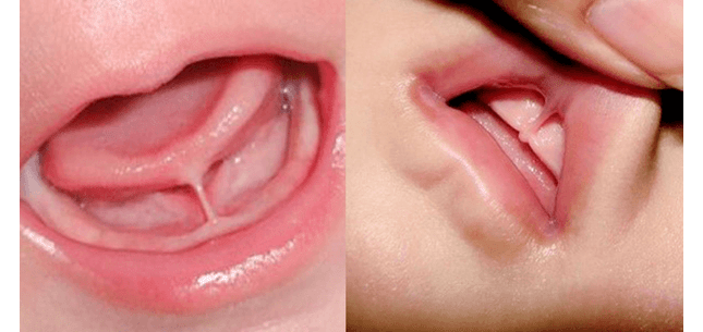 The Importance of Tongue and Lip-Tie Evaluation for Your Chi