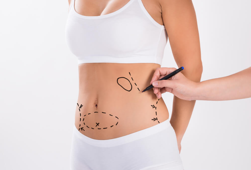 The Top 10 Benefits of Liposuction Unlocking Your Best Self Look