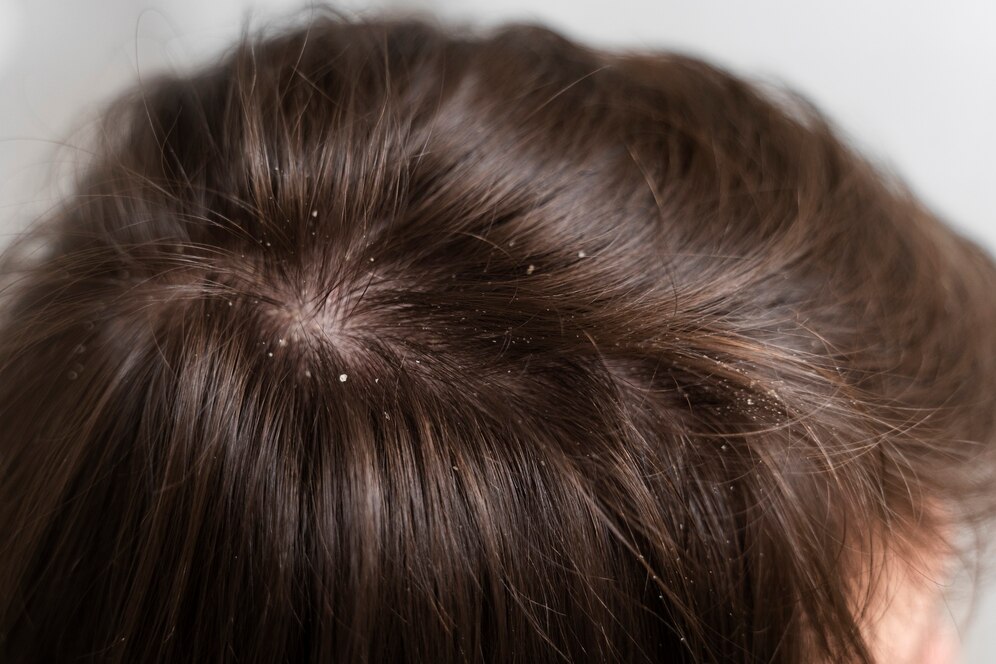 The Impact of Diet on Greasy Dandruff: What You Eat Matters