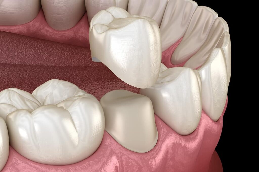 Are Dental Crowns Right for You? Everything You Need to Know