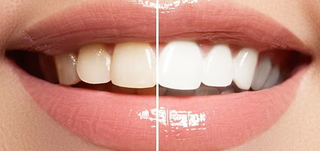 Say Goodbye to Stains: Effective Teeth Whitening Solutions