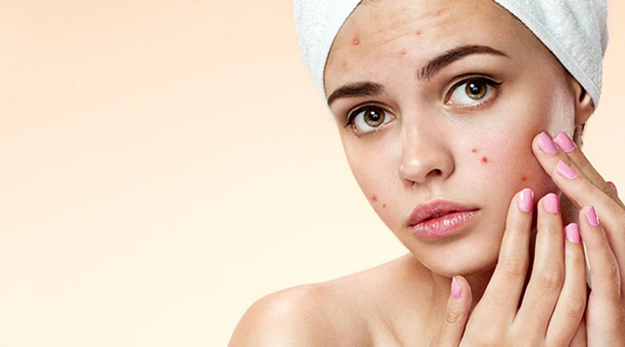 Best Acne Pimple Treatment: The Complete Guide to Clear Skin