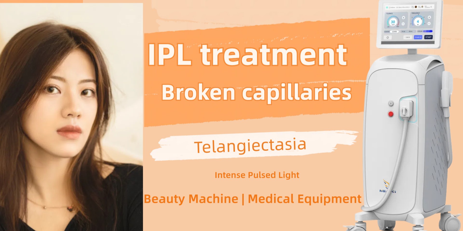 IPL treatment for broken capillaries, how to set the treatme