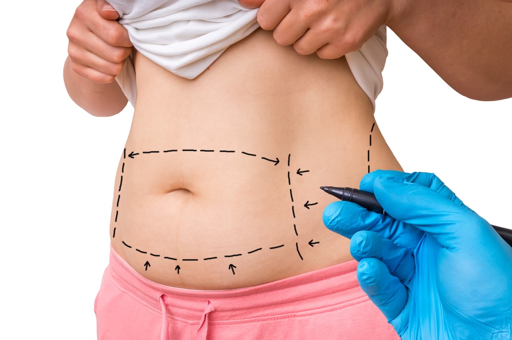 How to Maximize the Benefits of Your Tummy Tuck in Dubai