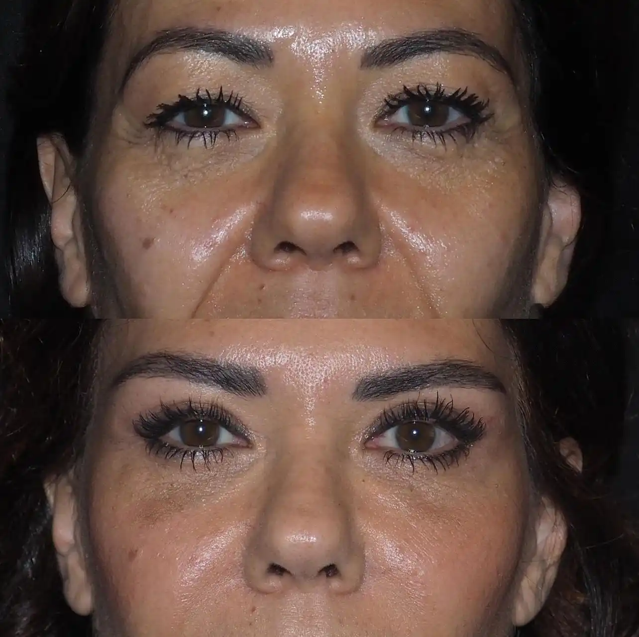 Comparing Eye Bag Removal Techniques Available in Dubai