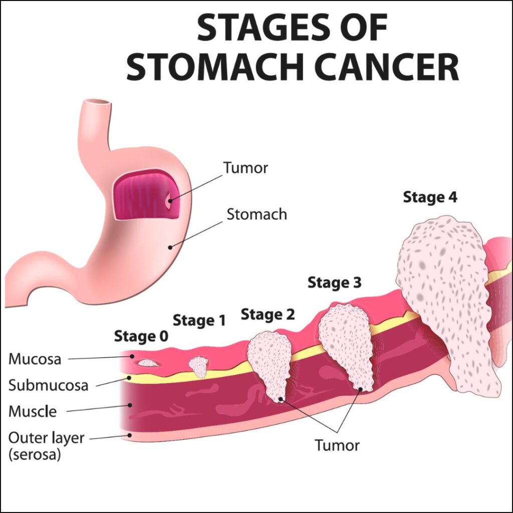 Gastric Cancer Drug Pipeline Analysis Report 2024