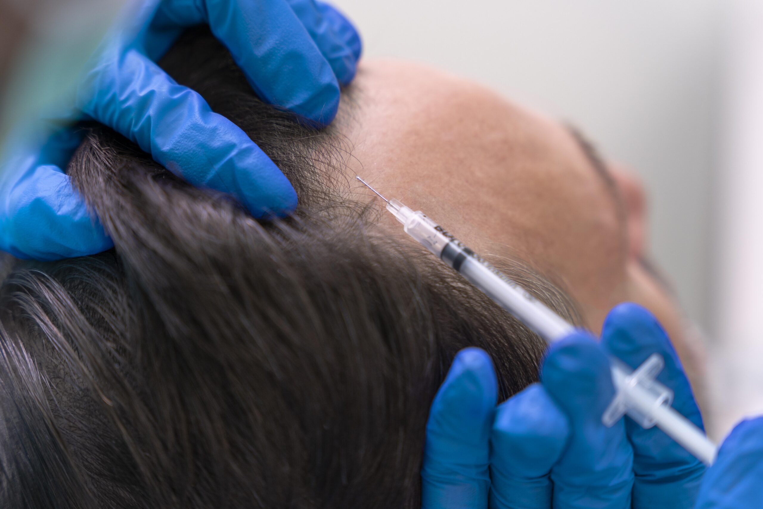 What Are the Benefits of PRP Hair Treatment for Hair Loss?