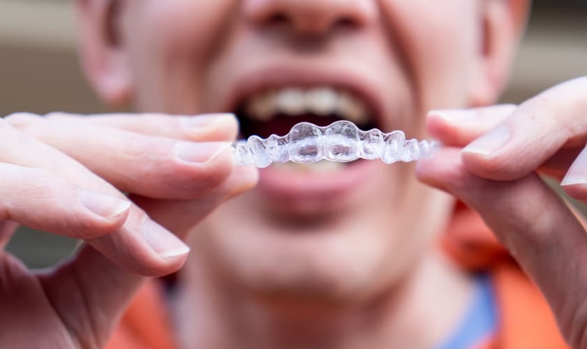 Can Invisalign Fix Overbites, Underbites, and Crowded Teeth?