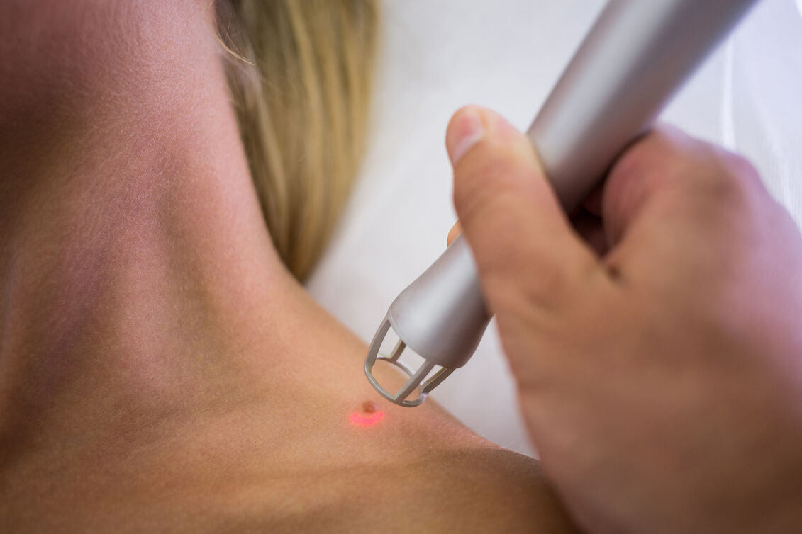 Laser Tattoo Removal Treatment: Rediscover Your Natural Skin